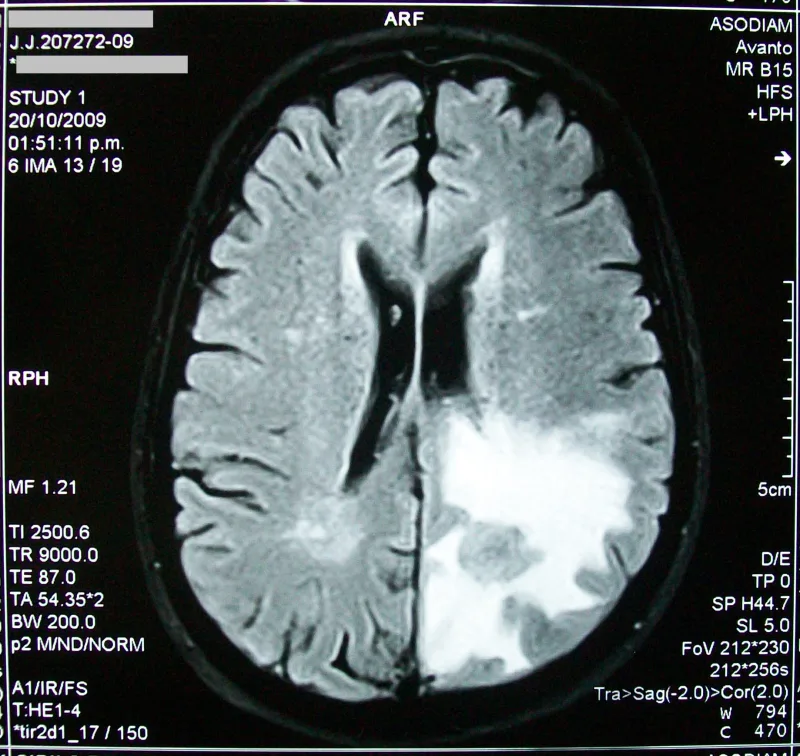 A sleeping brain may flag dementia years before memory does